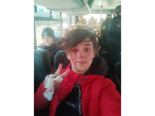 Vasily Tikhanov had his head smashed in St. Petersburg during his arrest. March 6, 2022 / Photo provided by Tikhanov